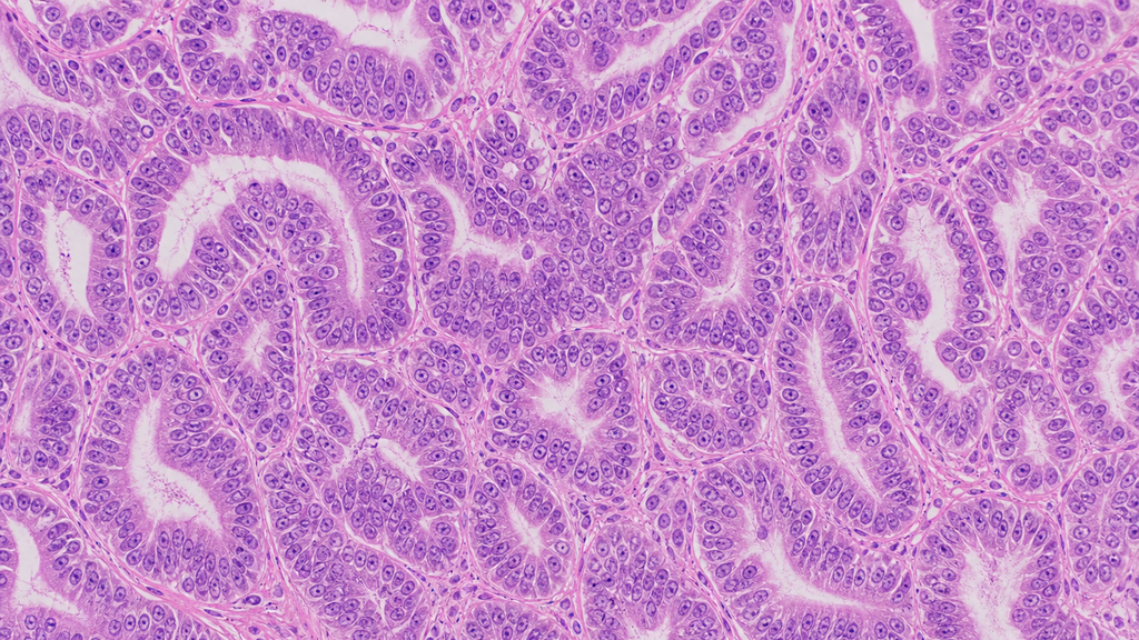 Fotografía editorial referencial generada para Síndrome de ovario poliquístico y riesgo de neoplasia endometrial