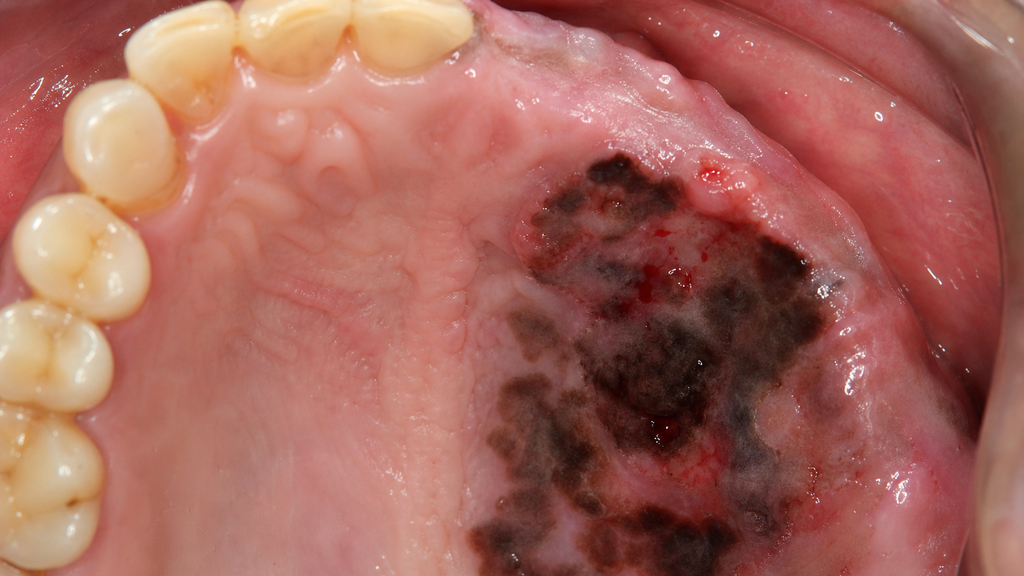 Una lesión palatina pigmentada, irregular, ulcerada y sangrante debe motivar biopsia y evaluación ganglionar urgente.. Imagen educativa generada por IA; no corresponde a un estudio diagnóstico real.